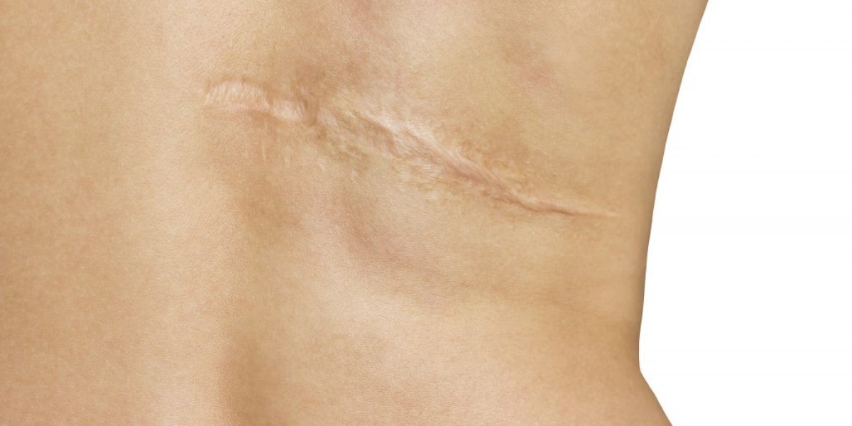 What Are the Benefits of Best Laser Scar Removal?