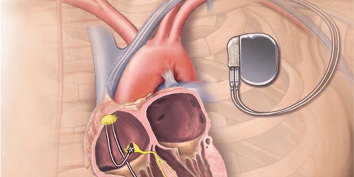 The Steady Beat of Innovation: Key Trends in the Cardiac Pacemaker Market