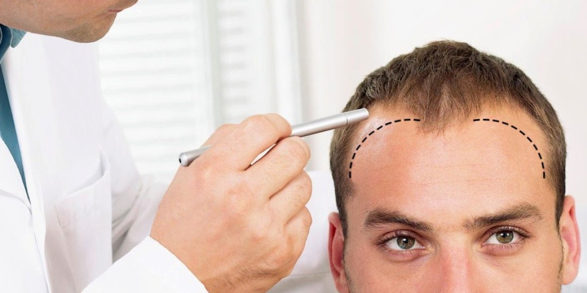 Hair Transplant Dubai: Non-Invasive Alternatives That Work