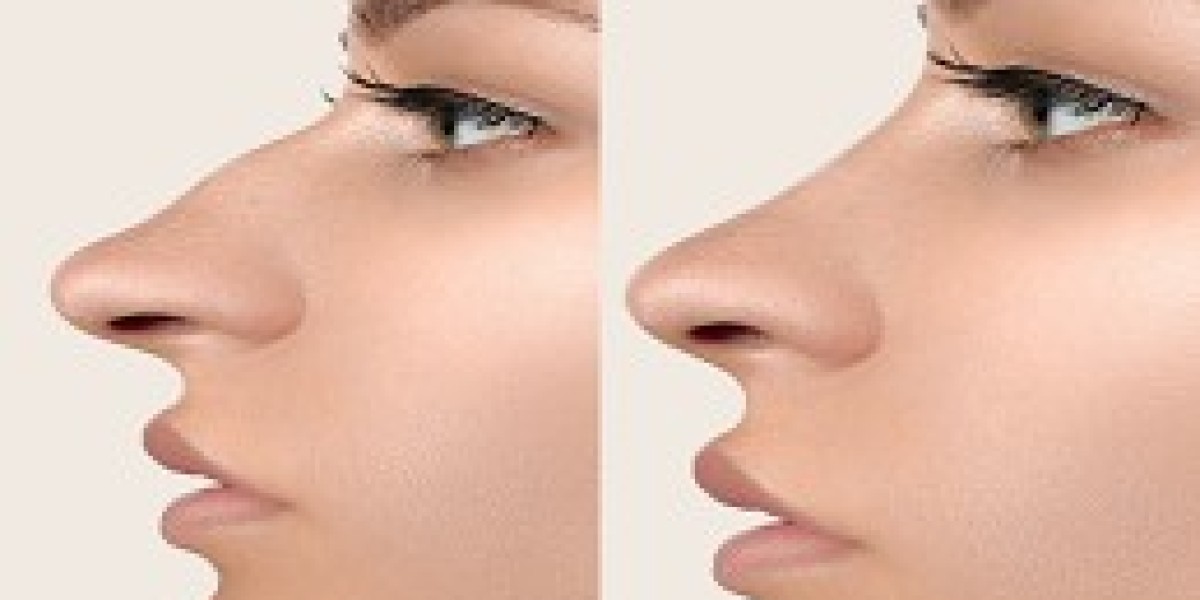 Rhinoplasty in Dubai: What to Expect Before, During, and After the Procedure