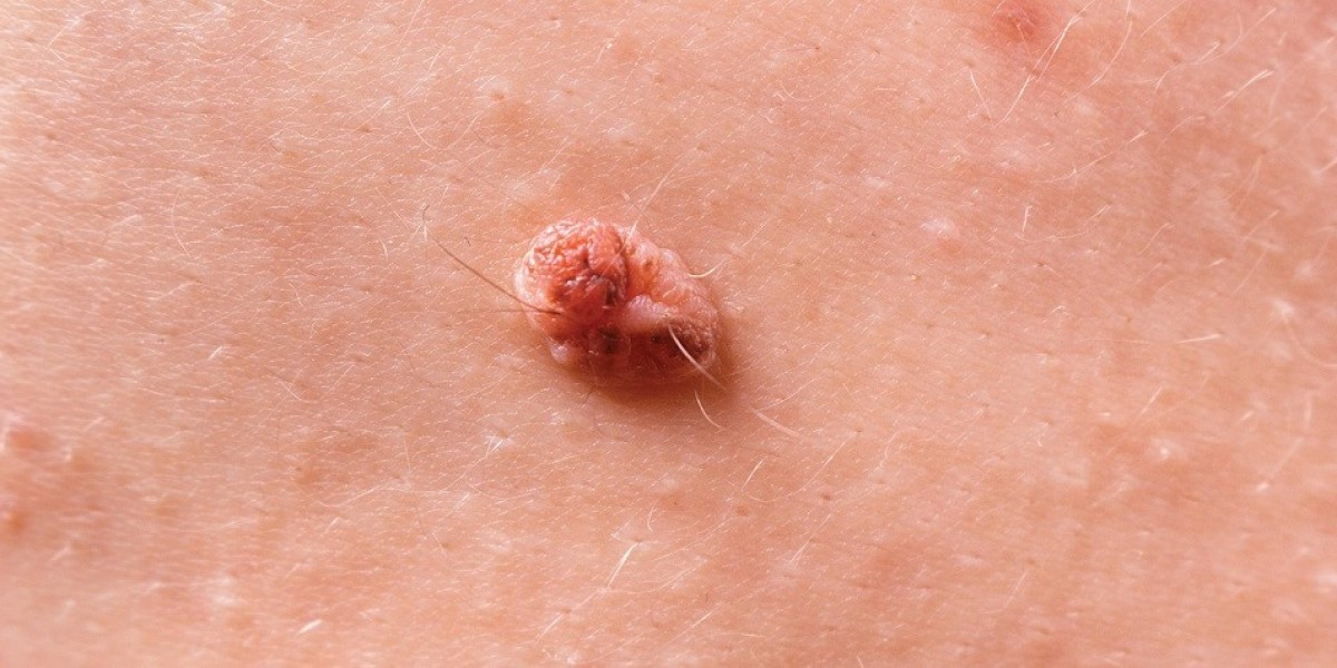How to Remove Skin Tags on the Inner Thigh Without Leaving Marks