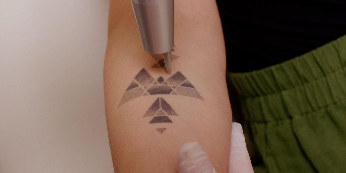 Ink-Free Feels Amazing with Laser Tattoo Removal in Dubai
