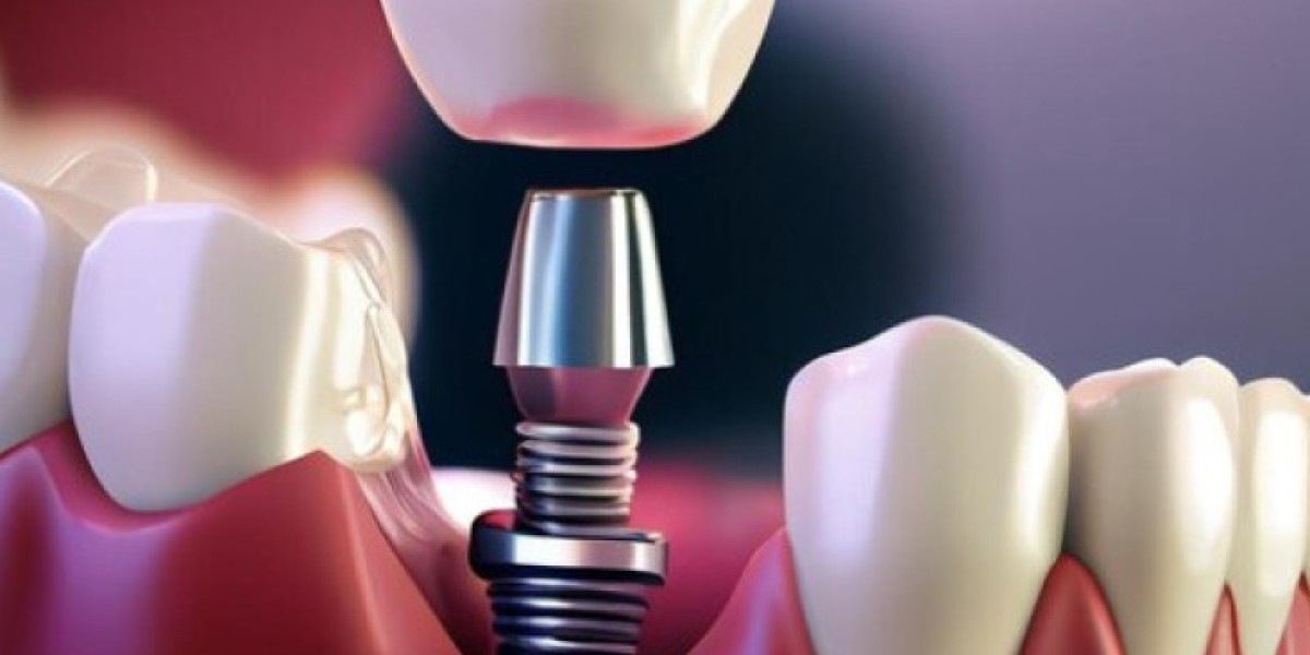 Technological Advancements Shaping the Future of the Dental Implants Market