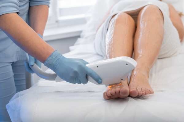 Laser Hair Removal in Banbury