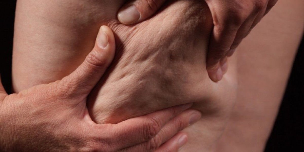 Can Men Benefit from Cellulite Treatment Too?
