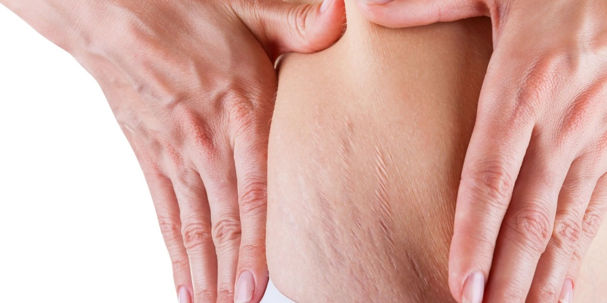 Laser Stretch Marks Treatment Explained Simply