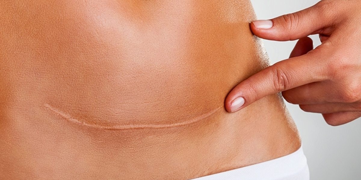 The Cost of Scar Laser Treatment in Dubai: Is It Worth It?