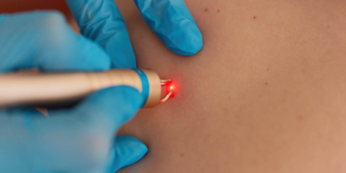 Warts Removal Treatments: How to Handle Recurring Warts Fast