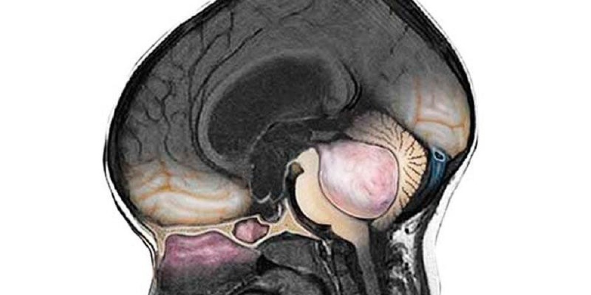 Medulloblastoma Drug Market Size, Trends, and Growth Analysis 2025-2032
