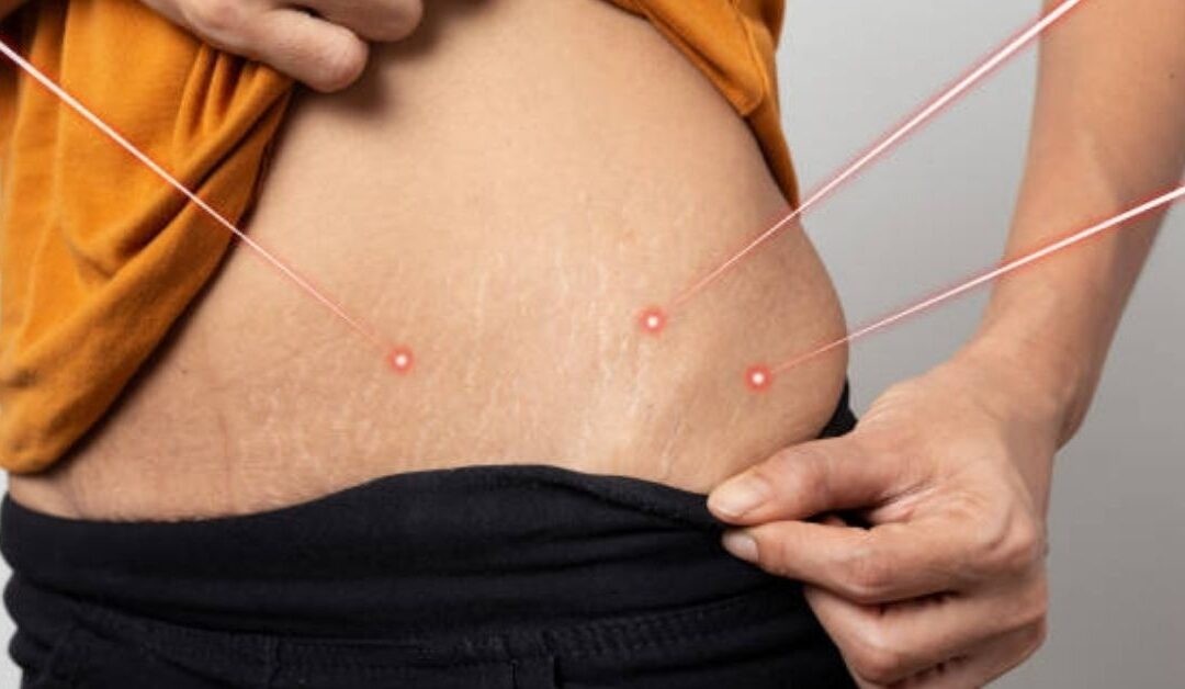 Laser Stretch Marks Treatment in Dubai