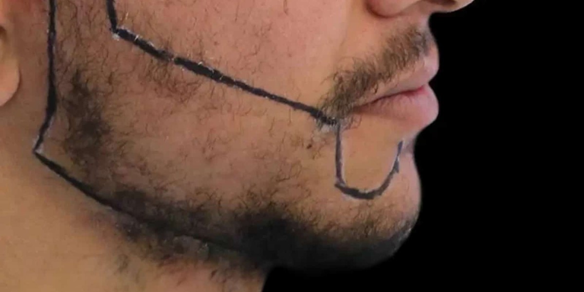 Can Beard Hair Transplant Fix a Patchy Beard Fast?