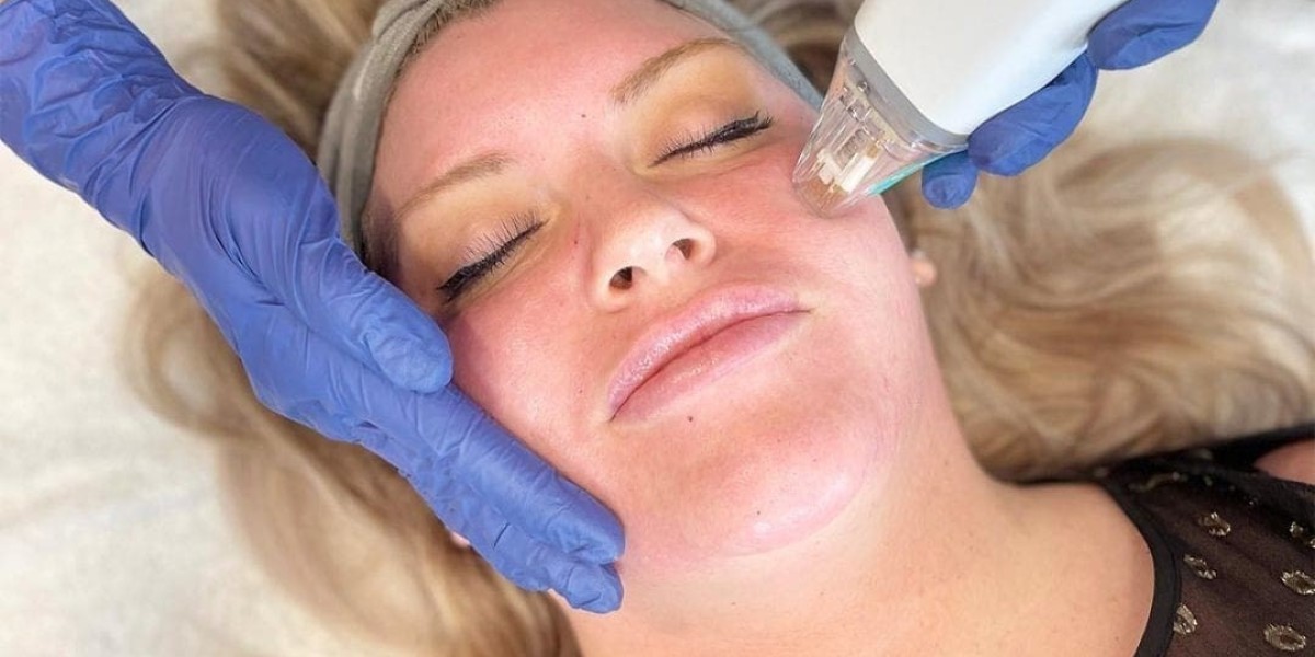 Skin Feels Alive Thanks to Fractional RF Microneedling