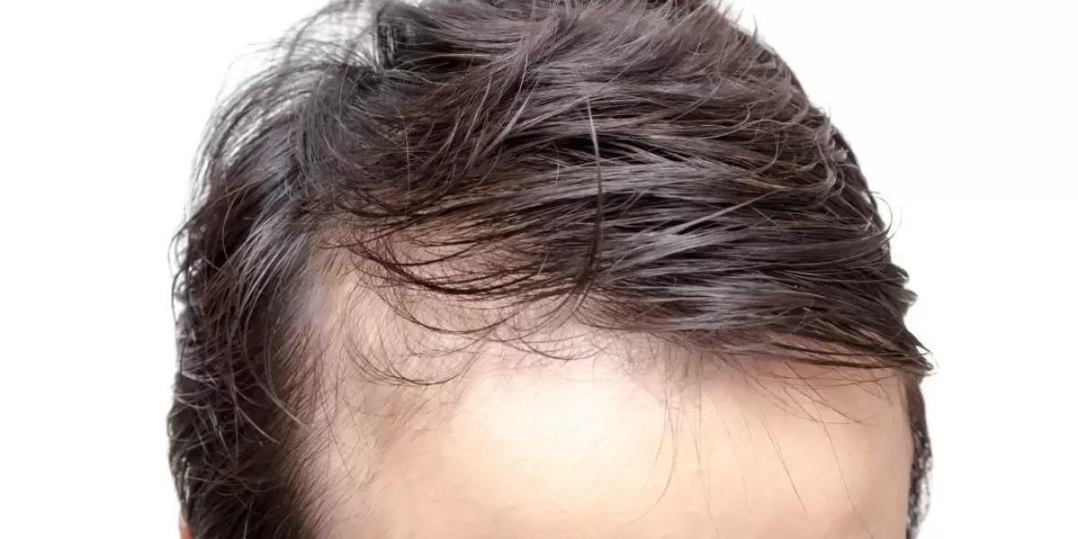 Benefits of Front Line Hair Fixing
