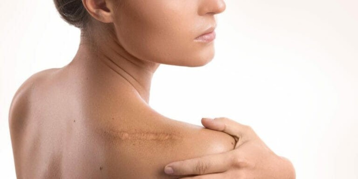 Comparing Laser Scar Removal Cost in Dubai Across Different Emirates
