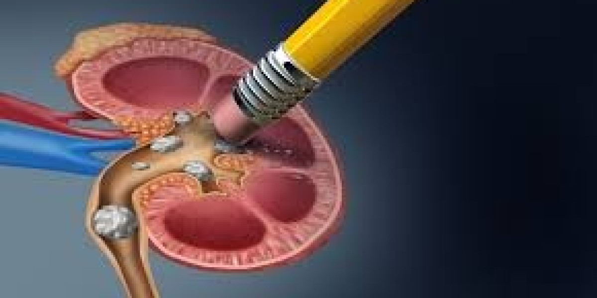 Kidney Stone Specialist & Advanced Removal Surgery at Urosonic