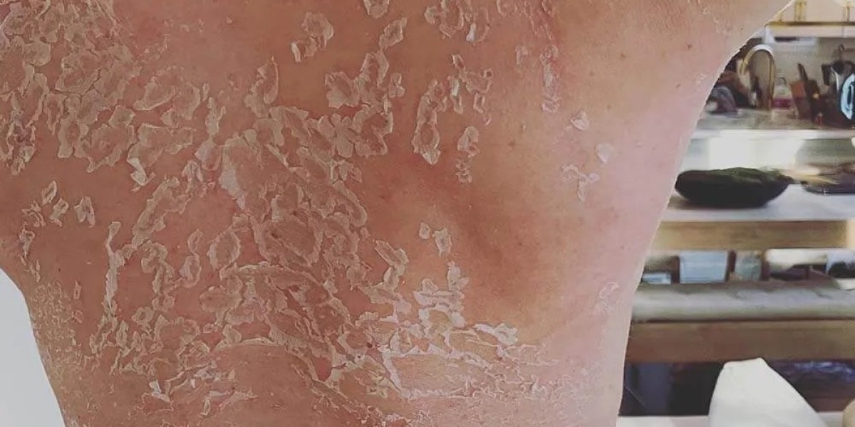 Can Glycolic Acid Peel Be Used on the Body?