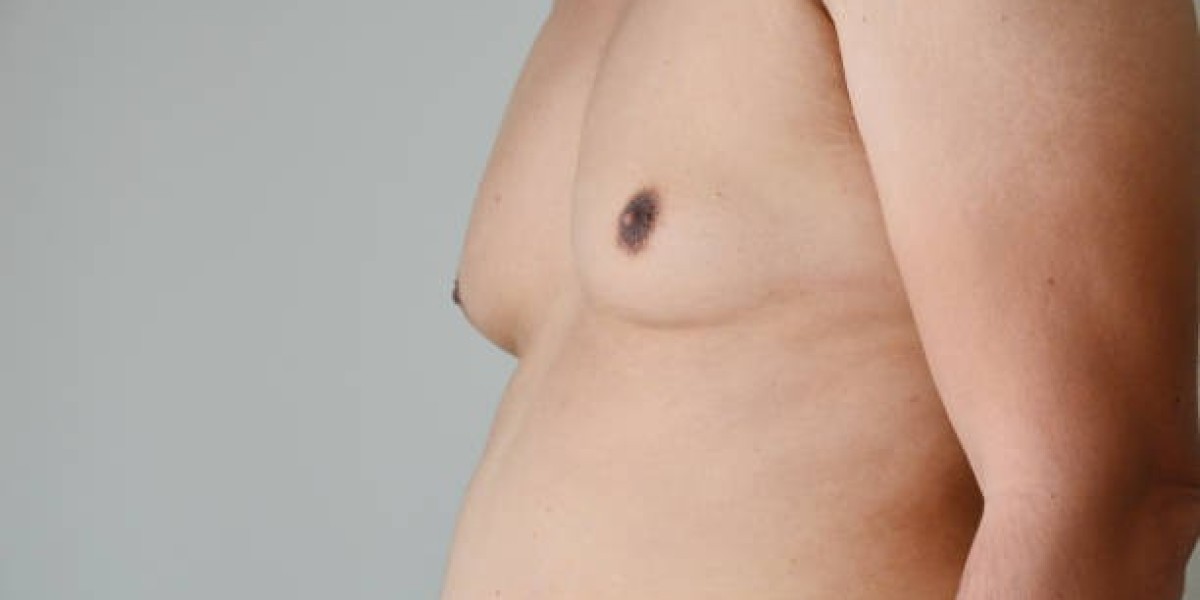 Steps to Prepare for Gynecomastia Surgery Riyadh