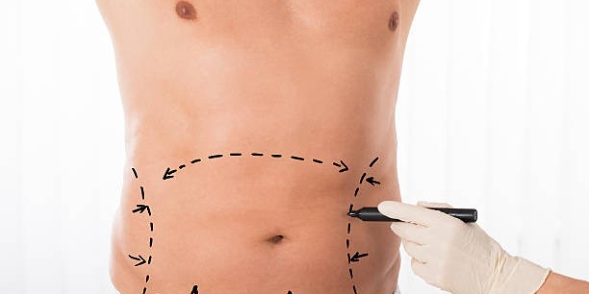 Tummy Tuck in Dubai: A Guide for Men on Achieving a Toned Abdomen