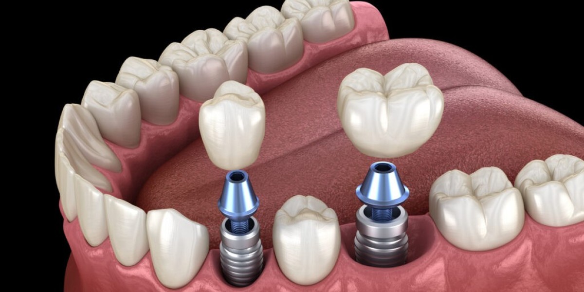 Shine Without Limits Boldly Now With Dental Implants in Dubai Glow