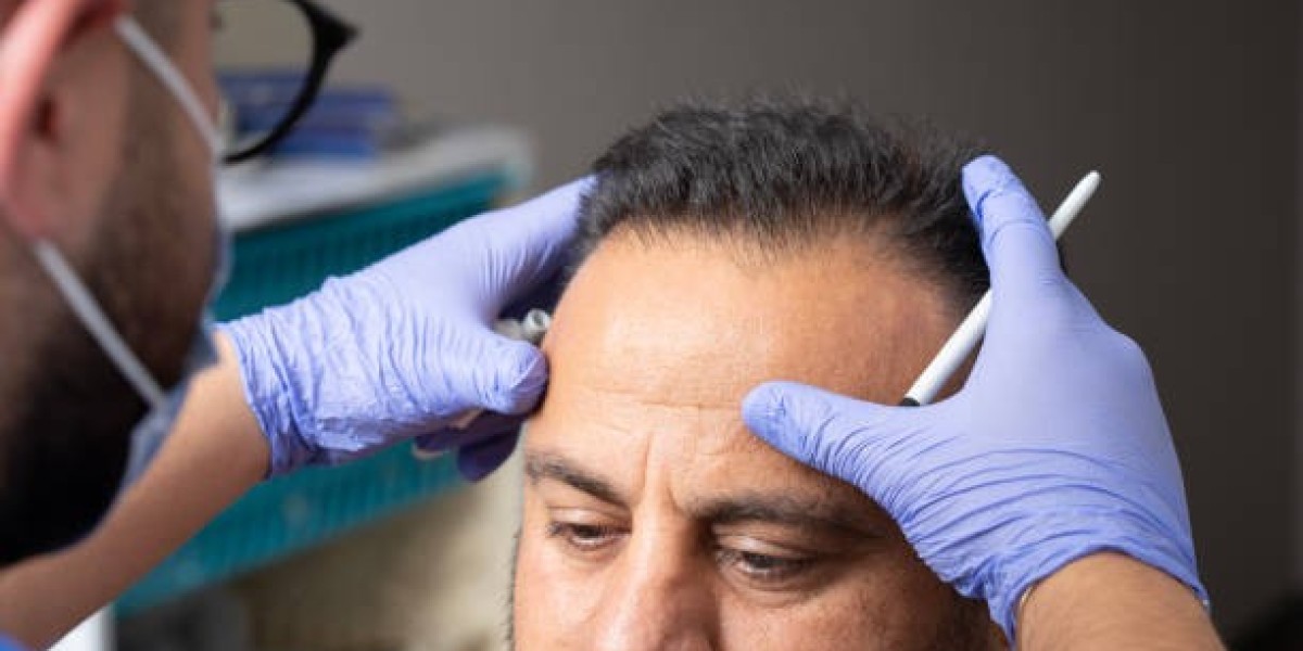 FUE Hair Transplant in Riyadh: Step-by-Step Guide