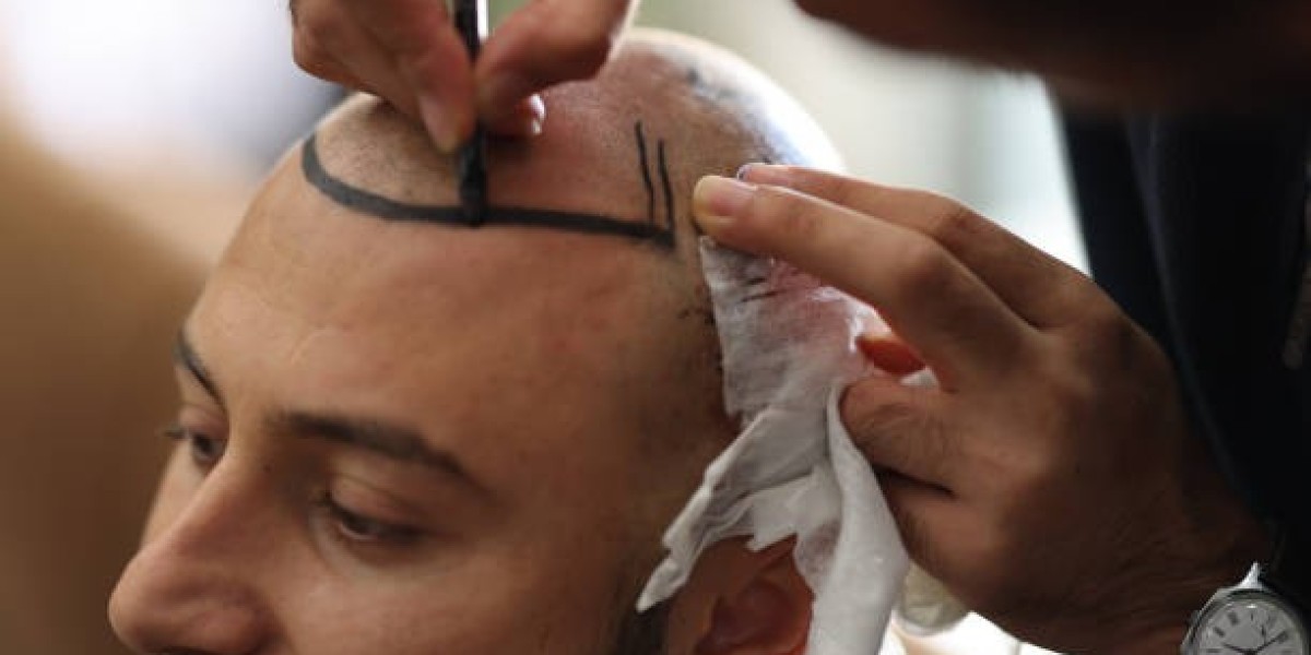 تعرف على طرق علاج الصلع وزراعة الشعر المتوسطة في الرياض