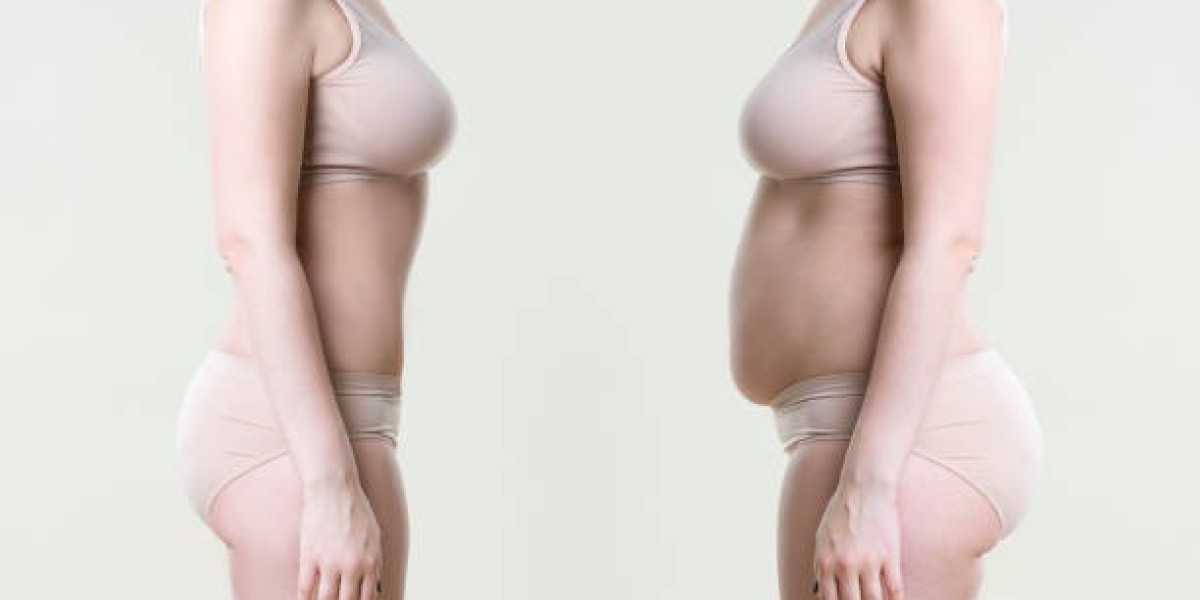 My Liposuction Experience: Tips for a Smooth Recovery