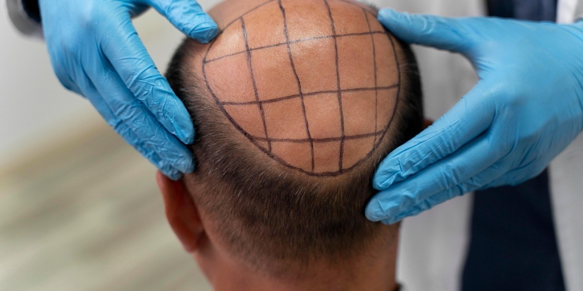 Natural-Looking Results: Hair Transplant Dubai Techniques Explained