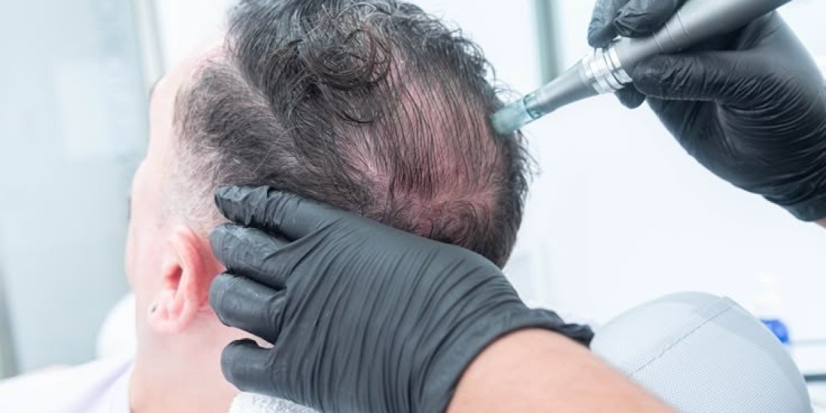 Riyadh Hair Transplant Recovery: Tips & Timeline