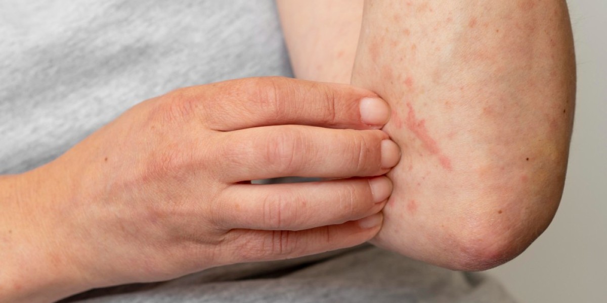 Understanding Chronic Spontaneous Urticaria