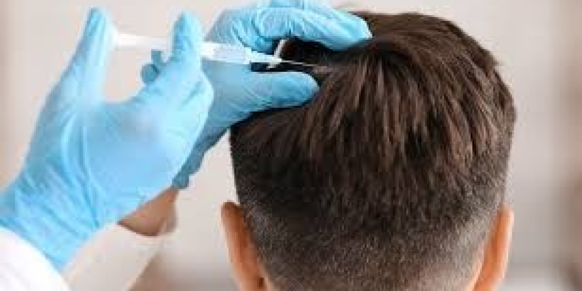 PRP Therapy: A Natural Solution for Hair Loss