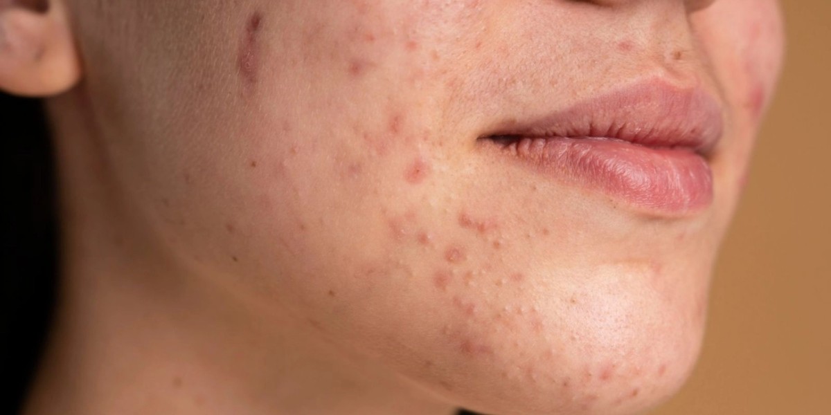 Does Erbium Peeling Lighten Pigmentation?