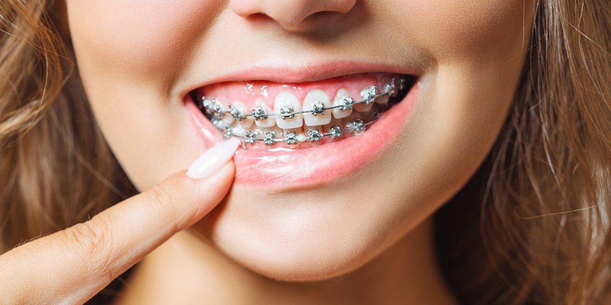 The Different Types of Braces Explained Simply