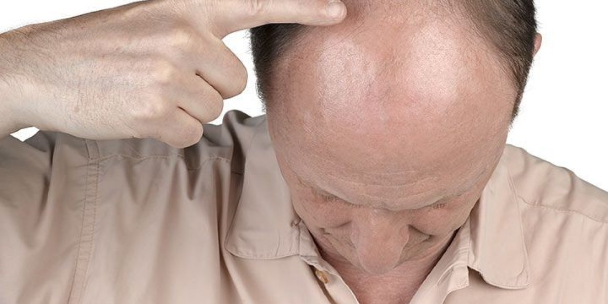 Regain Confidence with Rogaine, Minoxidil, and Tugain: Your Guide to Hair Regrowth