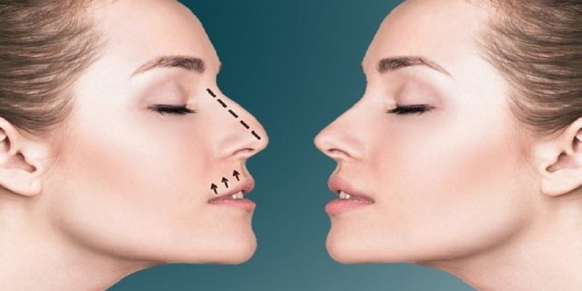 فترة التعافي بعد عملية تجميل الأنف بالرياض: مراحل ونصائح مهمة