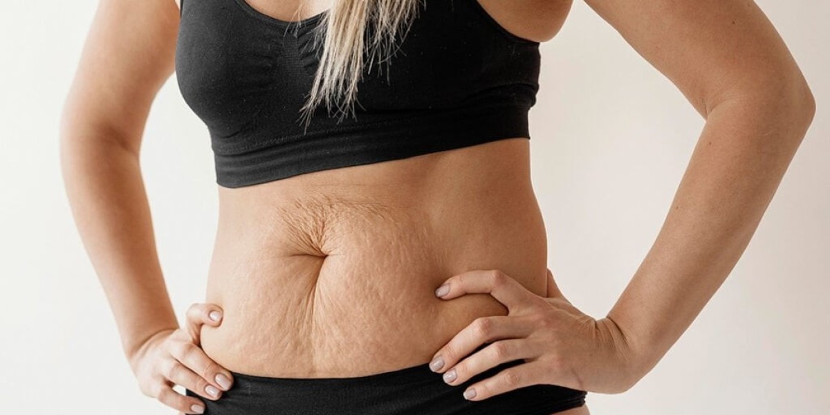 Can a Tummy Tuck Eliminate All Abdominal Stretch Marks?