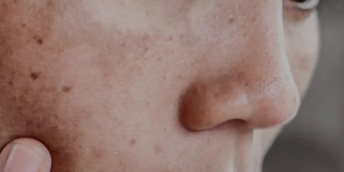 Is Dermal Pigmentation Treatment Permanent?