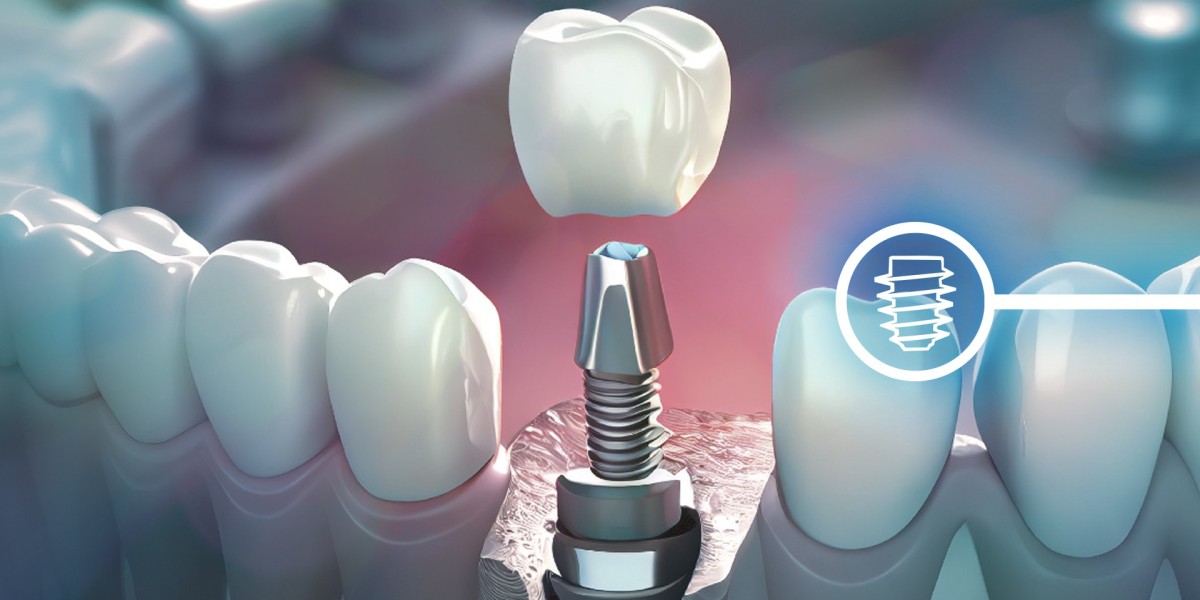 Full Mouth Dental Implants in Islamabad: Are They Worth It?
