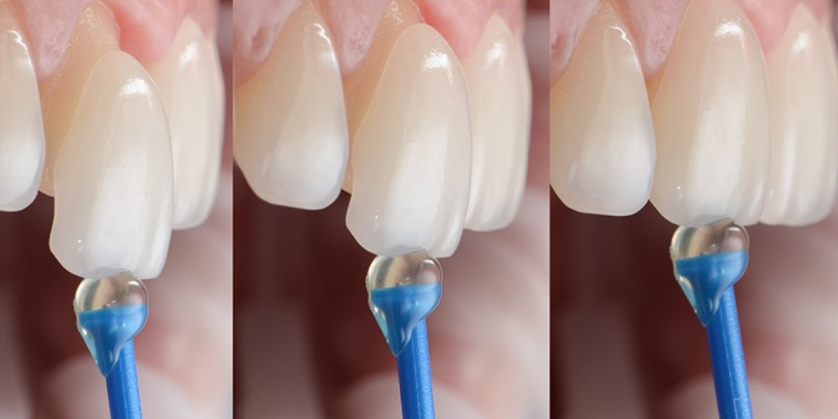 Can Dental Veneers Correct Uneven Tooth Sizes?