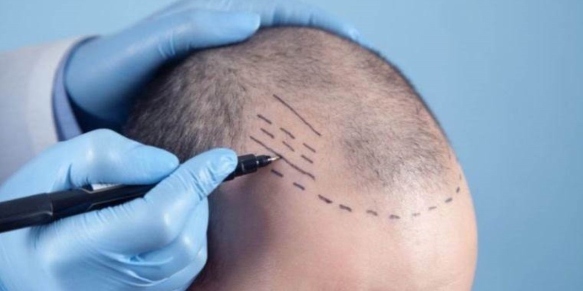 How to Prepare for a Hair Transplant in Riyadh: Step-by-Step Guide