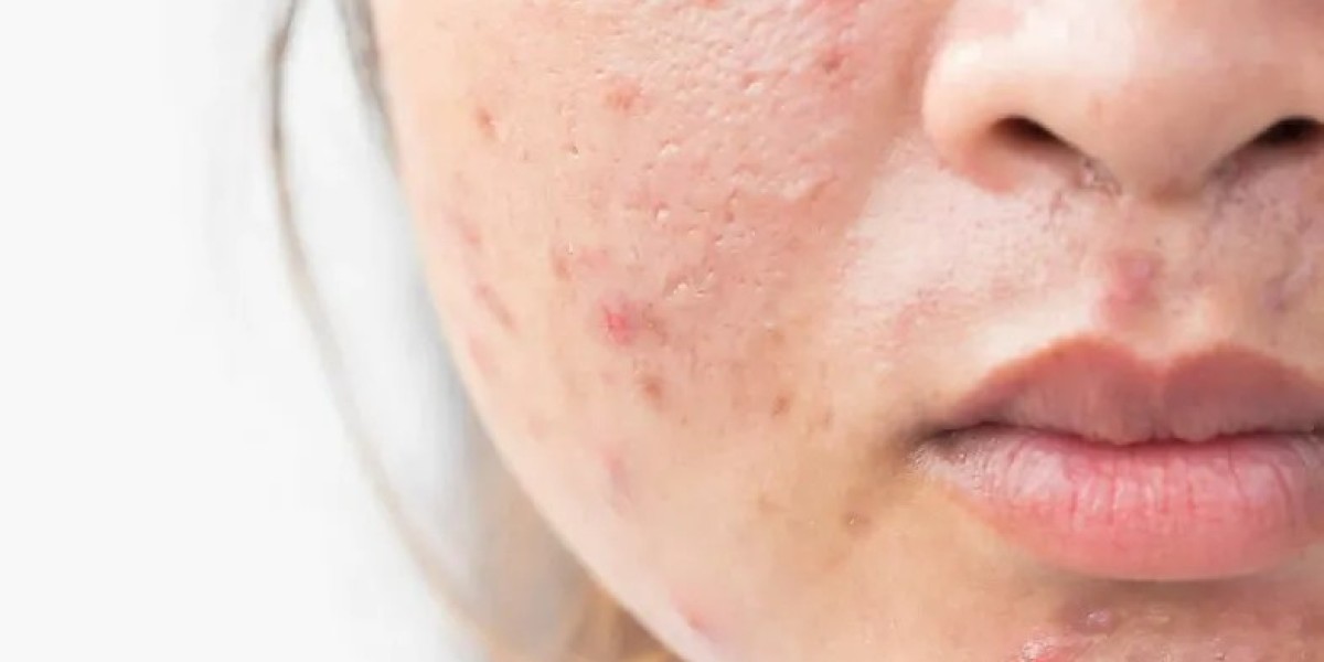 Can Face Rejuvenation Help with Acne Scars?