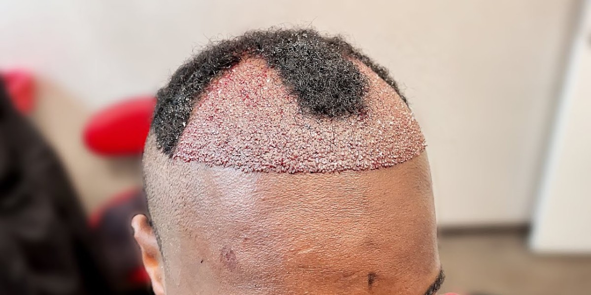 Why Hair Replacement is Becoming So Popular
