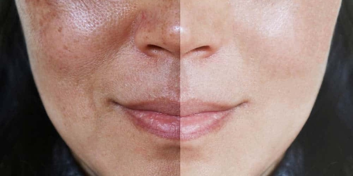 Best Pigmentation Treatment Procedures Recommended by Experts