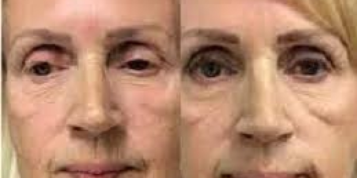 Reveal Youthful Skin with Microneedling in Islamabad