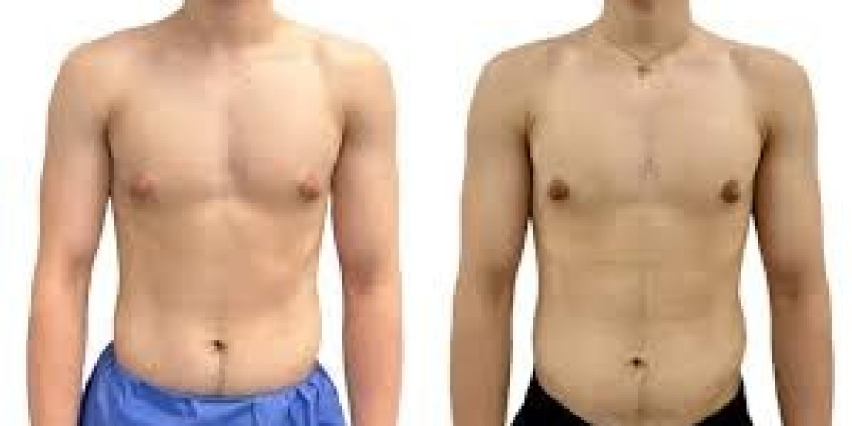 Gynecomastia vs Fat: Understanding the Difference and Treatment Costs in India