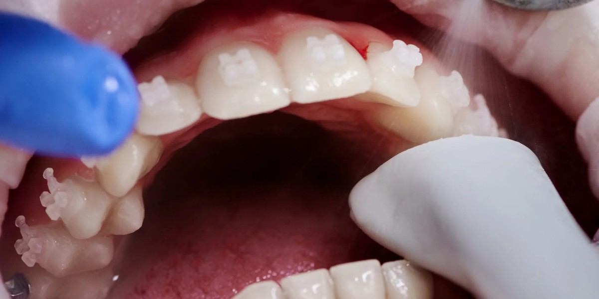 The Link Between Teeth Polishing and Fresher Breath