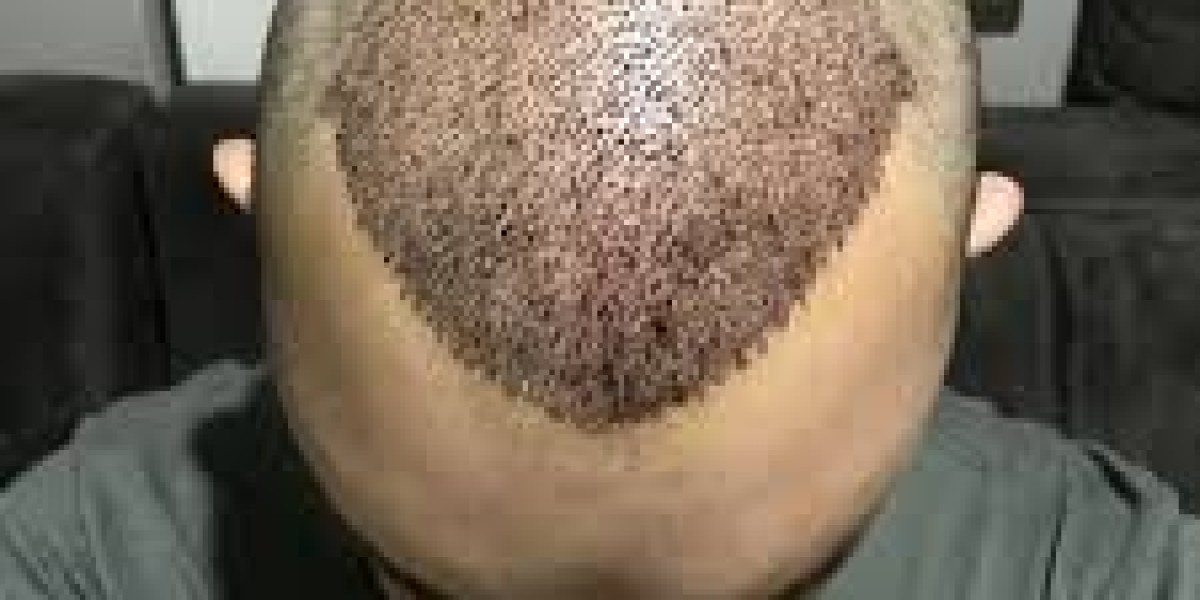 How to Find the Best Hair Transplant Surgeon in Islamabad