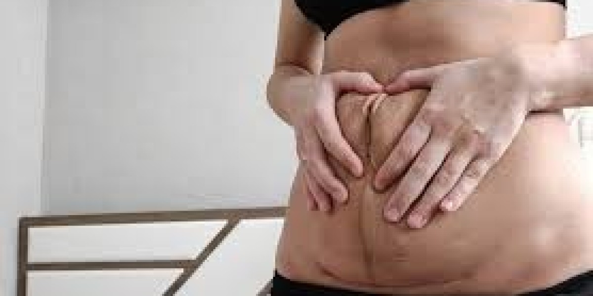 Can Tummy Tuck Treatment Be Done After C-section Birth?