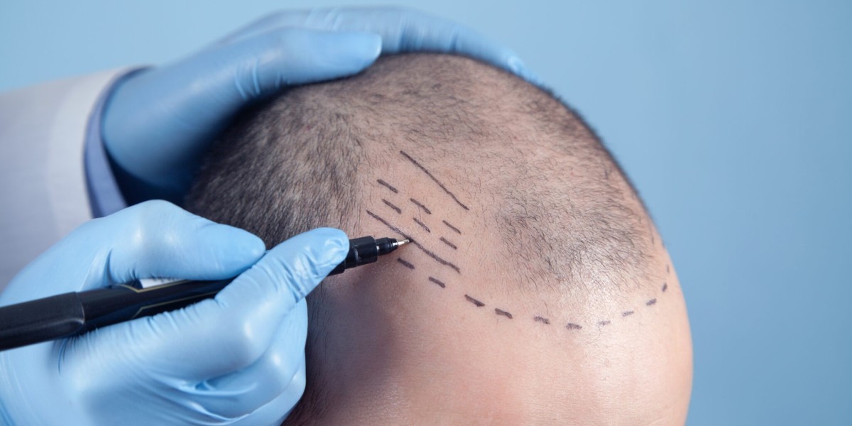 Hidden Costs You Should Know Before a Crown Hair Transplant