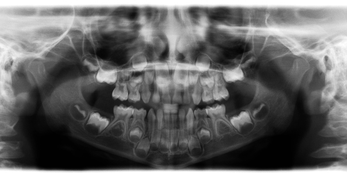 Don’t Overpay: Panoramic Dental X-Ray Cost Explained