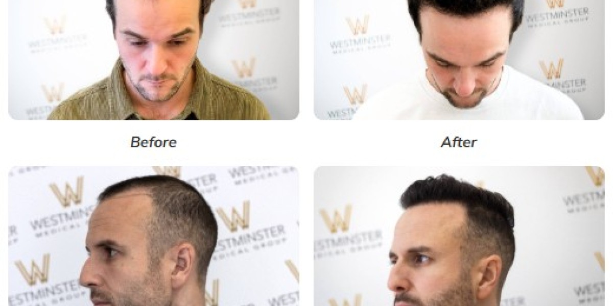 Understanding Hair Transplant Cost in London: What You Need to Know